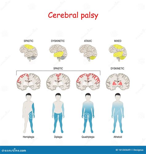 Cerebral Palsy Brain Compared To Normal Brain