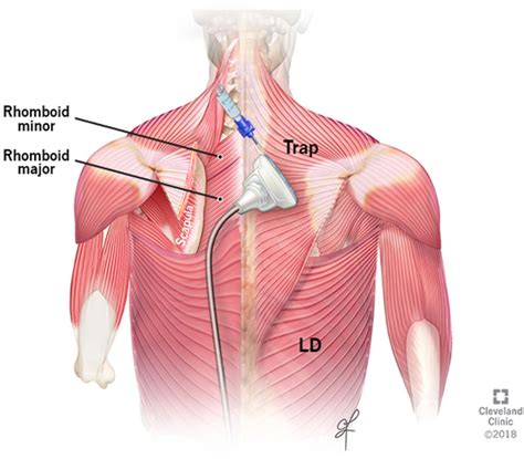 Intercostal Nerve Block