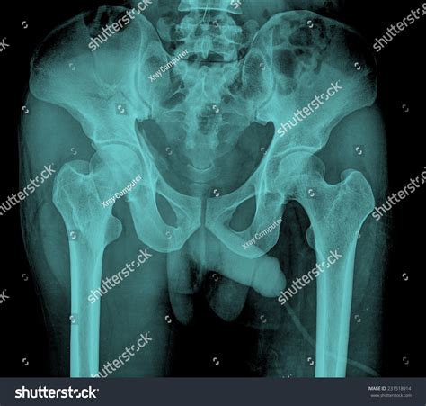 Xray Image Pelvis Hip Man Foto Stok 231518914 | Shutterstock