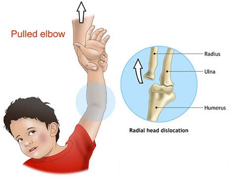 Dislocated Elbow - Causes, Signs, Symptoms, Recovery & Treatment