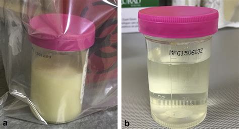 Cloudy urine in the postpartum period - Kidney International