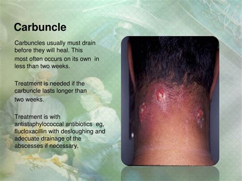 Image result for Removing Carbuncle