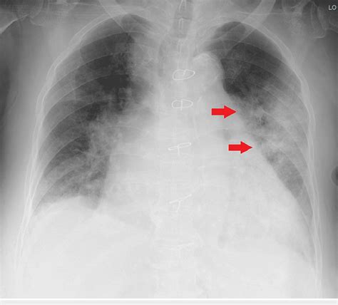 Hospital X-ray Chest 的图像结果
