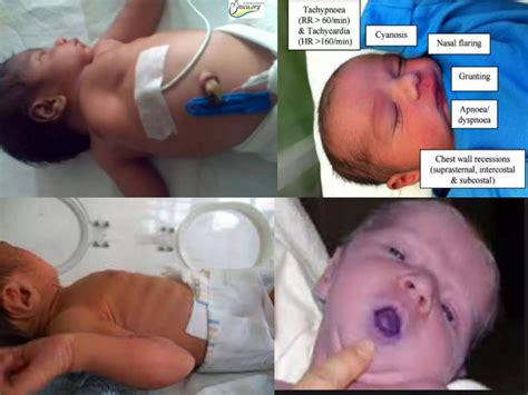 Respiratory distress syndrome | PPTX