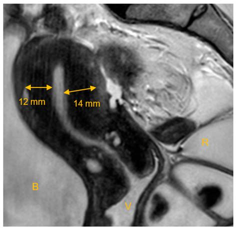 Impact of Adenomyosis on Infertile Patients—Therapy Options and ...