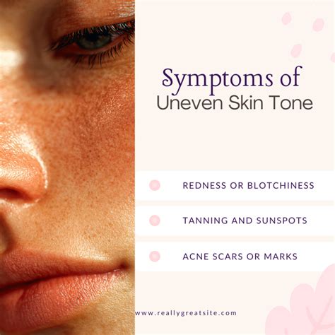Uneven Skin Tone Types, Causes, Symptoms & Treatment
