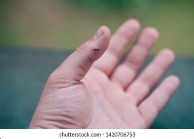 Splinter Finger 的图像结果