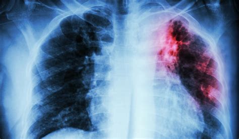 New hope for treatment of tuberculosis- The Week