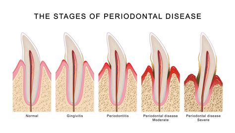 Stages Of Gingivitis
