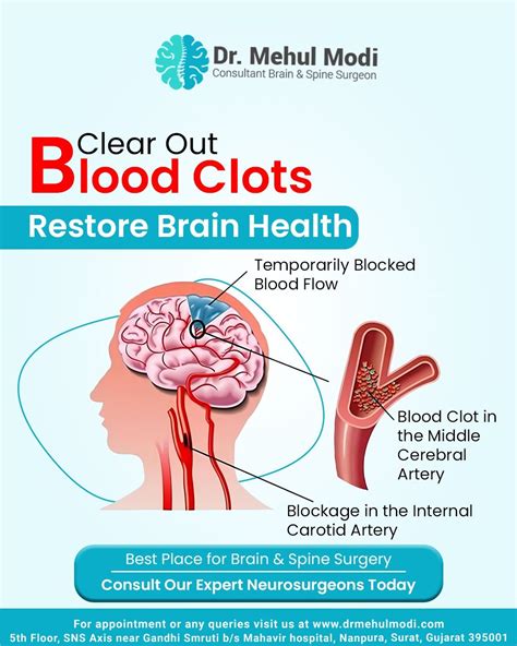 🧠 BLOOD CLOTS IN THE BRAIN? | Dr. Mehul Modi