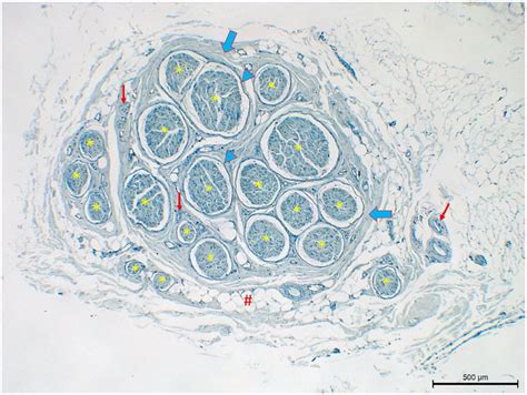 Microanatomic analyses of extratemporal facial nerve and its branches, hypoglossal nerve, sural ...
