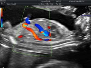 Bildergebnis für 2 vessel umbilical cord ultrasound