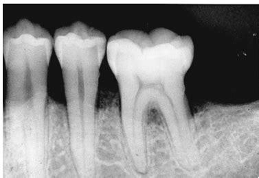 Image result for Two Walled Defect Perio