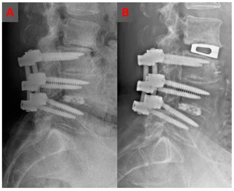 Stand-Alone Oblique Lumbar Interbody Fusion (OLIF) for the Treatment of ...