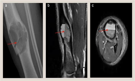 Management of paediatric benign bone tumour - Paediatrics and Child Health