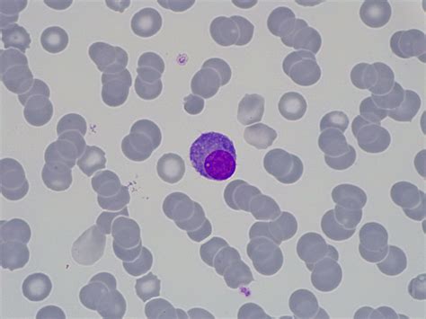 Plasma cell leukaemia
