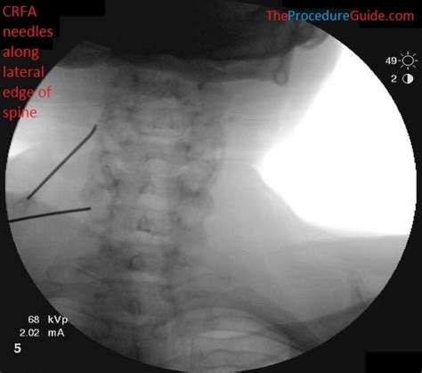 Image result for Shoulder Injection Fluoroscopy