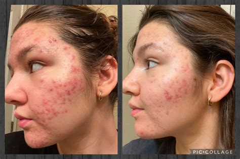 purging or breakouts from benzoyl peroxide??? : r/acne