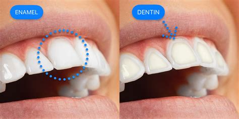 Teeth Sensitivity? Causes, Treatment & Prevention