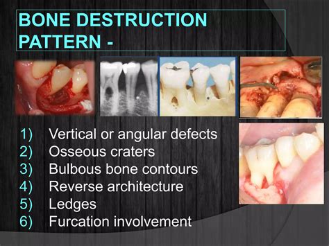 Bone loss and patterns of bone destruction | PPTX