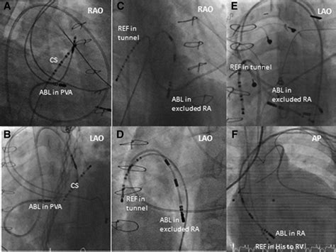 Contemporary Outcomes of Supraventricular Tachycardia Ablation in ...