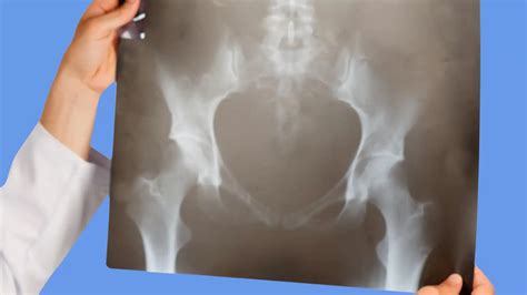 Hip Joint Effusion: What Patients Need to Know | HipXpert