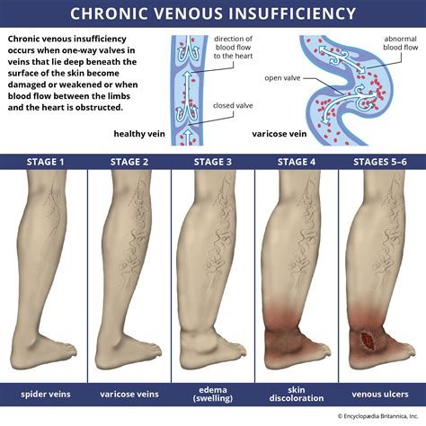 Chronic venous insufficiency | Description, Risk Factors, Symptoms ...