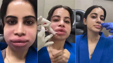 What Happens After Dissolving Lip Fillers? Urfi Javed’s Swollen Face ...