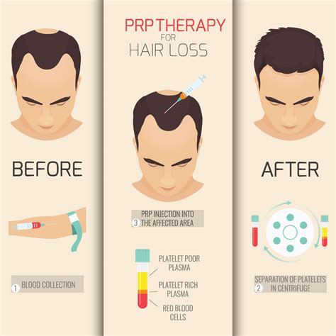 PRP Hair Loss Treatment | Sydney, Melbourne & Brisbane