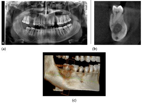 Various Surgical Interventions in Treating Odontogenic Keratocyst: A ...