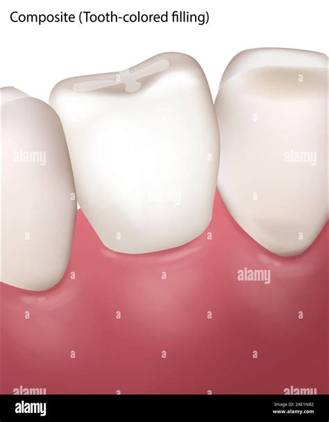 Dental Filling Procedure. Amalgam Silver filling and Composite Tooth colored filling Stock ...