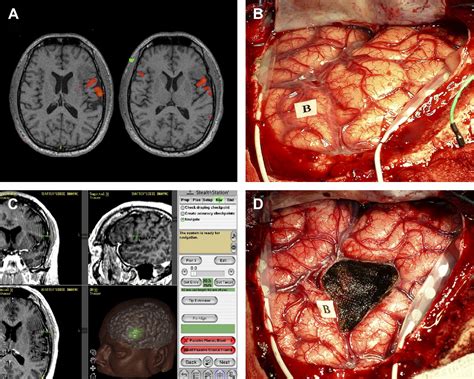 Advances in Brain Tumor Surgery - Neurologic Clinics