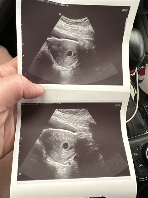 6 weeks 3 days Ultrasound. Twins? — The Bump