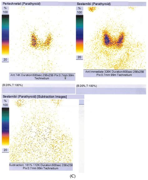 Paget’s Disease of Bone and Normocalcemic Variant of Primary ...