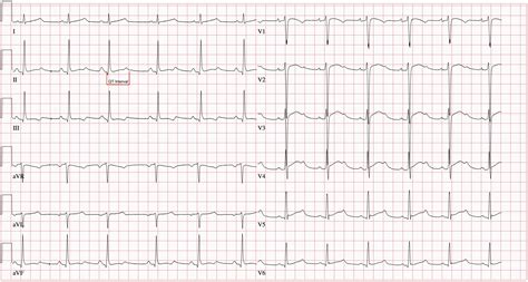 Long QT Syndrome - Dr Mark Perrin