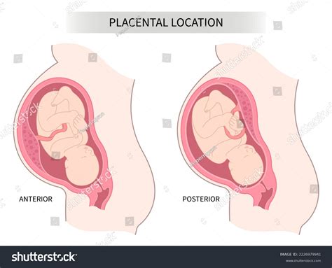 What Does Posterior Right Lateral Placenta Means at Sabrina Swensen blog