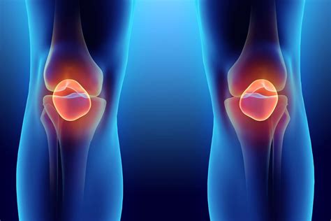 Patella Alta & Baja: Causes & Treatment – Orthokinetics