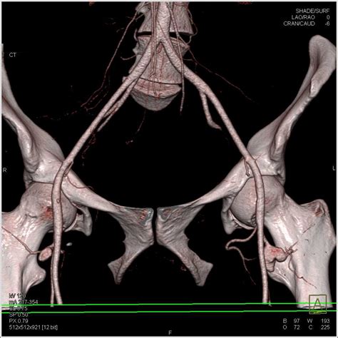 Aneurysms off the Femoral Arteries - Vascular Case Studies - CTisus CT Scanning