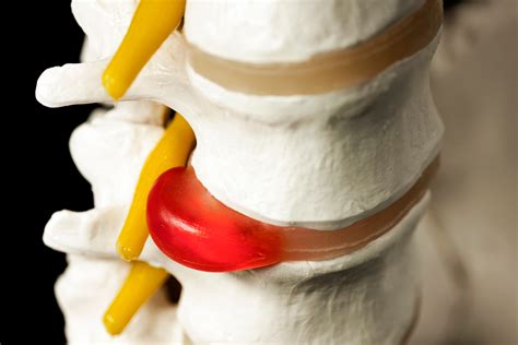 Herniated Discs, Bulges, and Pinched Nerves: What's What? | Dorsal