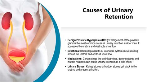 Urinary Retention Common Causes, Symptoms And Treatment.pptx