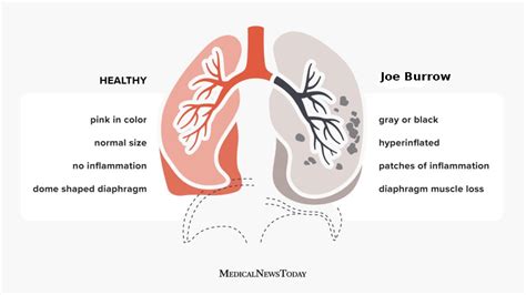 Emphysema Life Expectancy 的图像结果