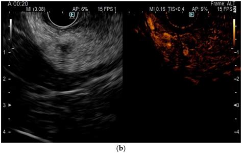 Endoscopic-Ultrasound-Guided Radiofrequency Ablation for Pancreatic Tumors