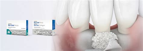 Periodontal Treatment - Geistlich Pharma AG