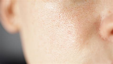 What Causes Large Pores on Skin?