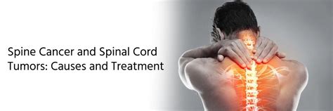 Spine Cancer and Spinal Cord Tumors: Causes and Treatment