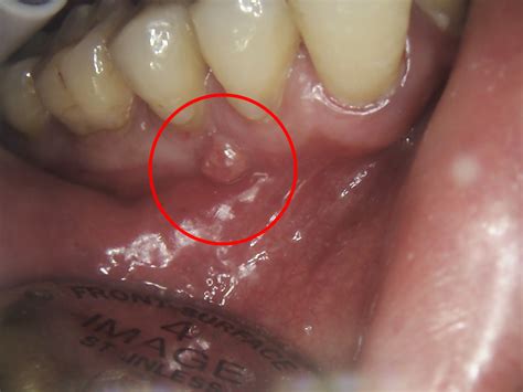 Popping Abscess Tooth 的图像结果