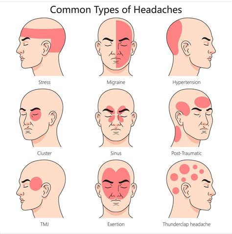 Best 13 Understanding Different Headache Locations and Their Meaning – Artofit
