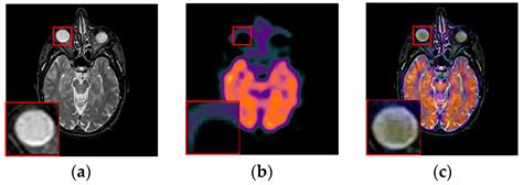 A New Dictionary Construction Based Multimodal Medical Image Fusion ...