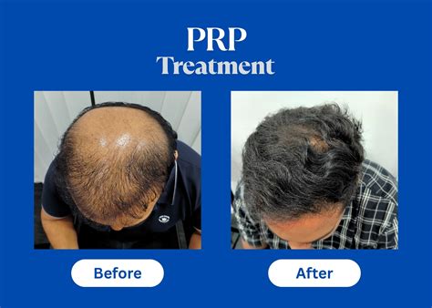 PRP Before & After: What to Expect on Your Treatment Path