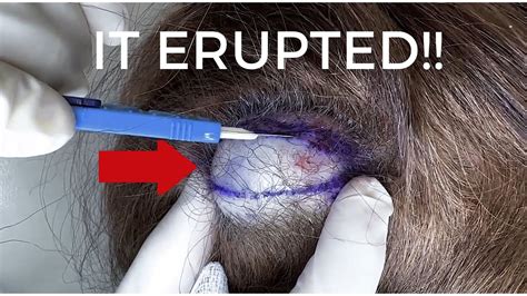 Exploding Cysts Compilation 的图像结果